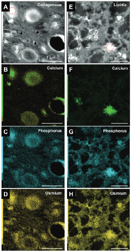 STEM EDS images of human sclerotic tissues to show elemental concentrations.